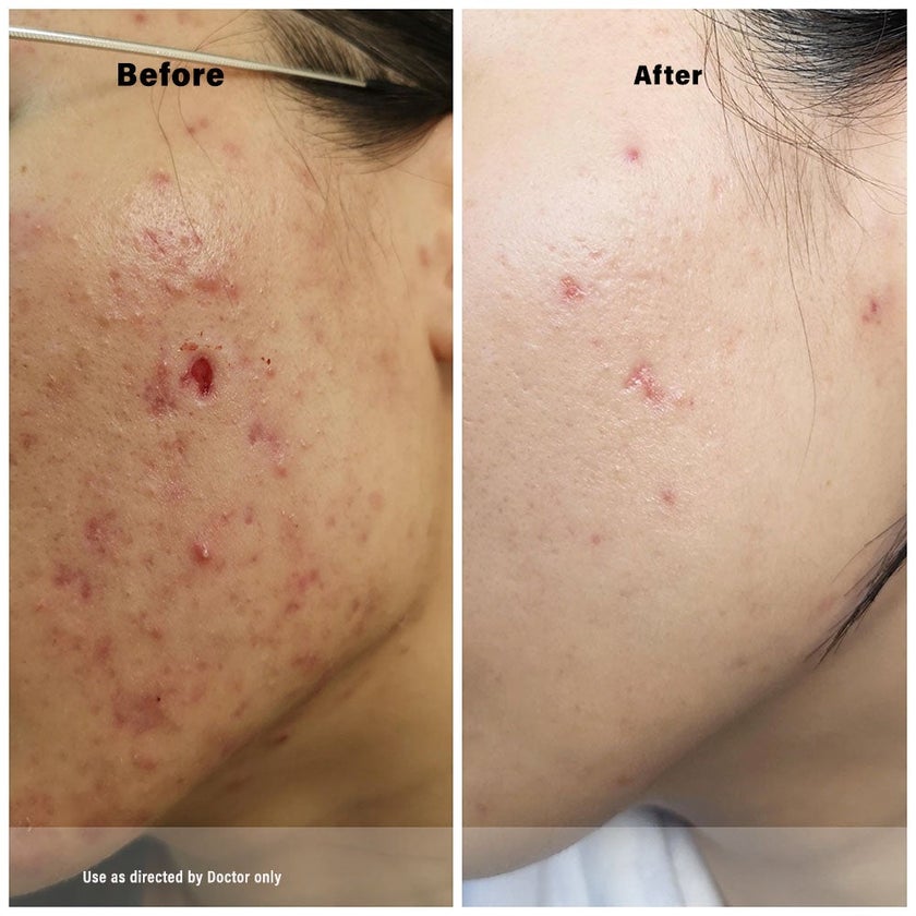 Acretin 0.05% Topical Cream 30g