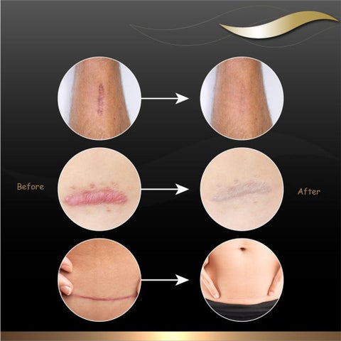 Dermatix Silicone Gel 15g
