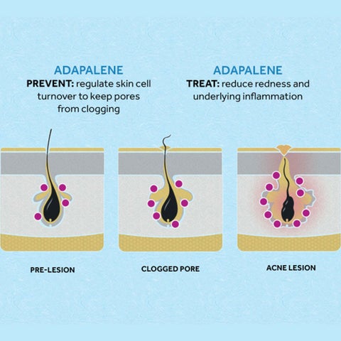Differin 0.1% Adapalene Cream For Acne 30g