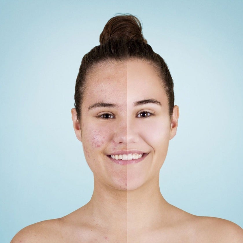 Differin 0.1% Adapalene Cream For Acne 30g