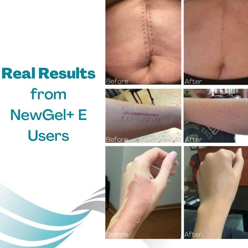 NewGel+E Advanced Medical-Grade Silicone Gel + Vitamin E for All Scar Types 15g