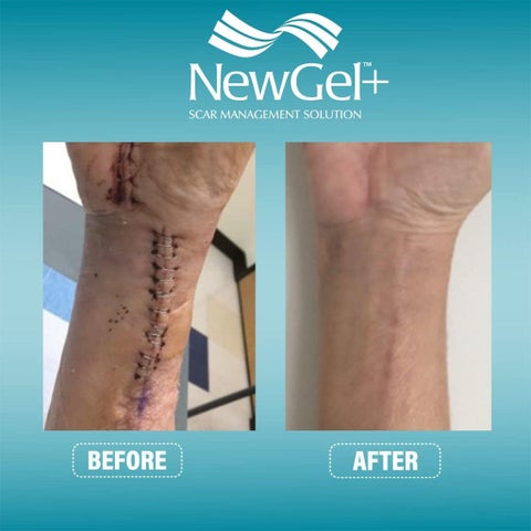 NewGel+ Silicone Gel Strips For Scar Marks - NG-364