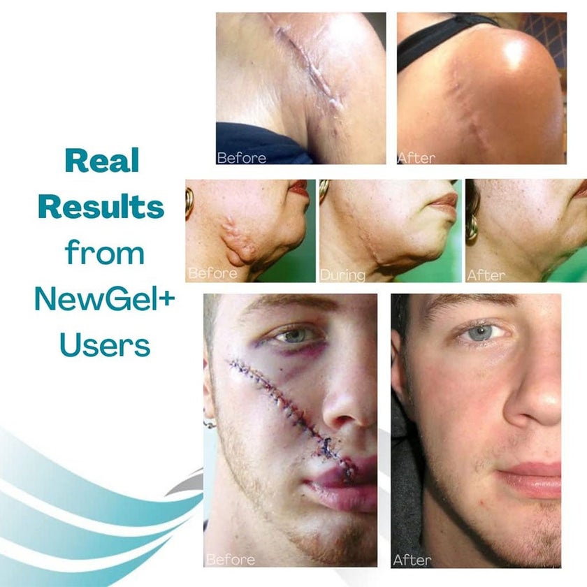 NewGel+ 24" x 2" Abdomen/Extremity Silicone Strip, Clear - NG-364