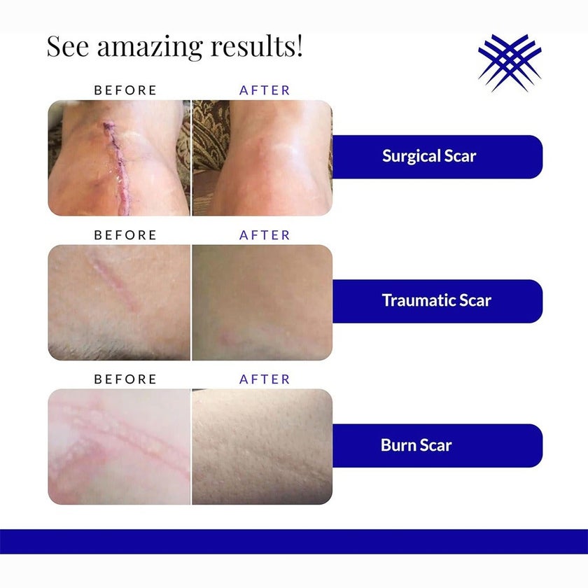 Rejuvasil Silicone Scar Gel 15ml