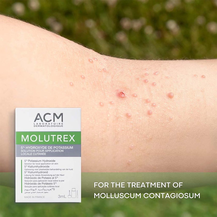 ACM Molutrex 5% Potassium Hydroxide Topical Solution For Molluscum Contagiosum 3ml