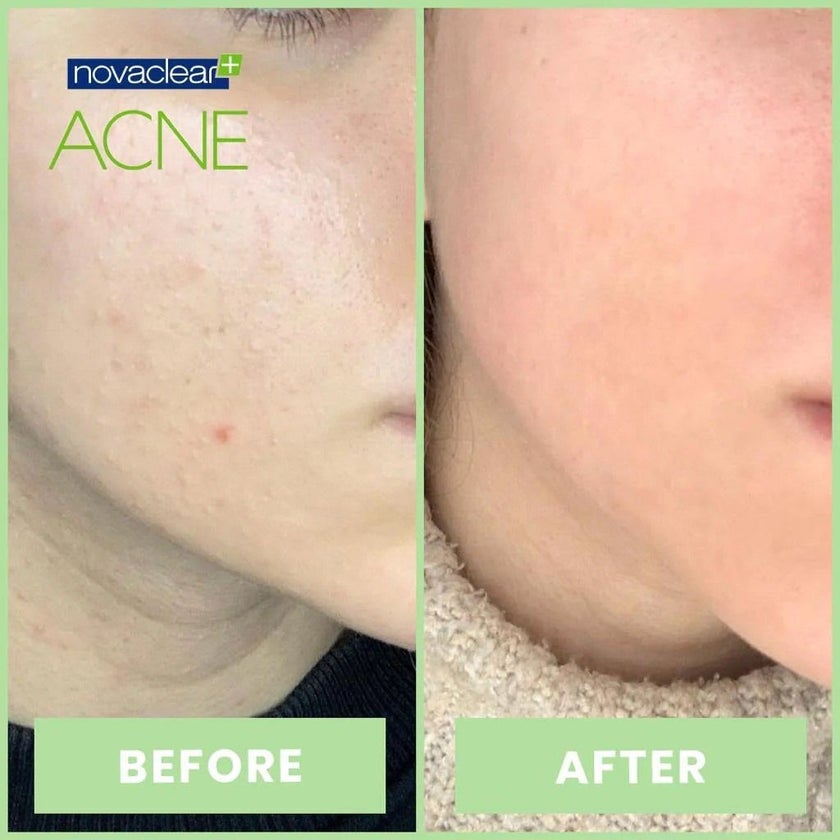 Novaclear Acne Cream With Salicylic Acid For Oily And Acne Prone Skin 40ml