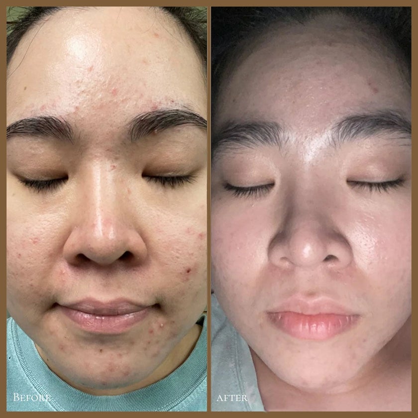 GlowBiotics Probiotic Clarifying Home Peel For Acne With AHA and BHA 15ml