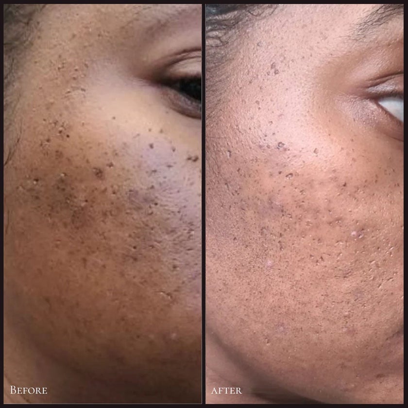 GlowBiotics Probiotic Triple Action Acne Clarifying Pad With Non-Drying AHA & BHA, Pack of 45's