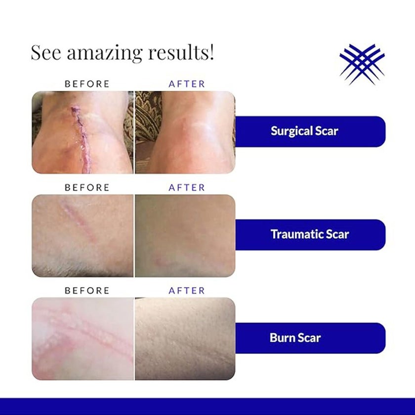 Rejuvaskin Scar Esthetique Scar Removal Cream With Silicone 30ml