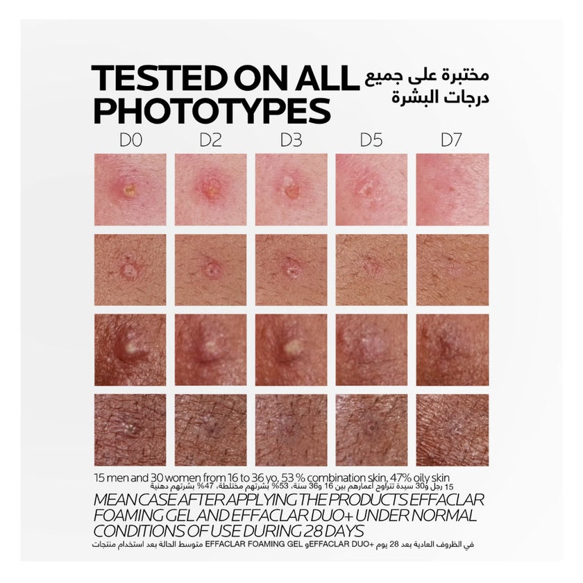 La Roche-Posay Effaclar Duo+M Acne Treatment Cream, Acne Prone Skin - 40ml