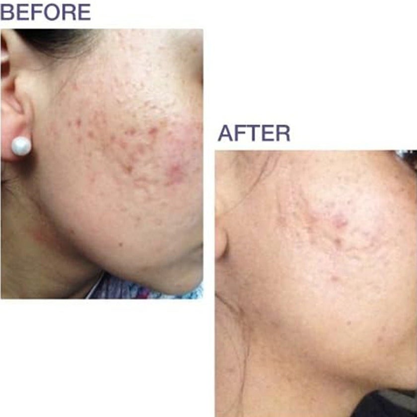 Biodermis Prosil SPF15 Silicone Stick For Scars 4.25g