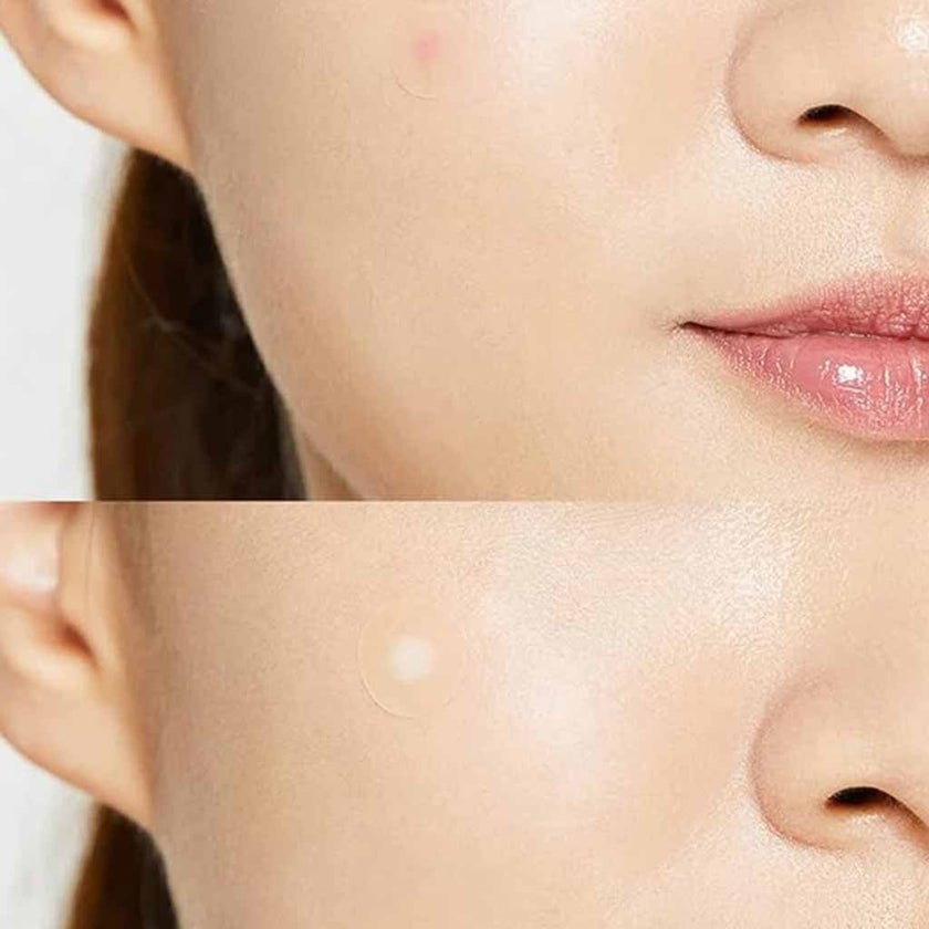 Cosrx Acne Pimple Master Patch, Pack of 24's