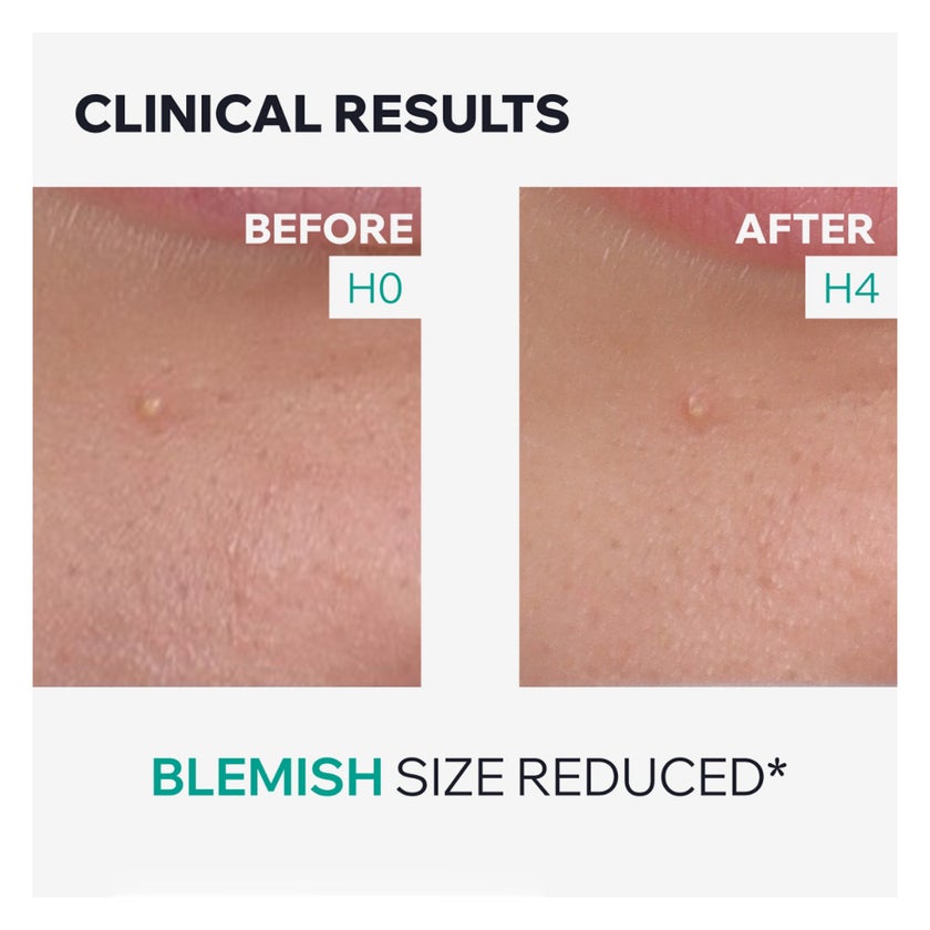 Uriage Hyseac SOS Drying Gel, Blemish & Dark Spots, 15ml