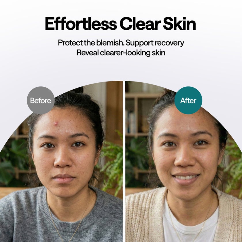 Elle Magnesium Acne Patches, 11mm & 10mm - 45 Patches